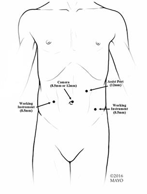 Robotic-Assisted Bladder Neck Procedures for Incontinence in Pediatric Patients